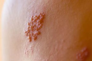 5 Tanda Herpes Awal, Jangan Tunda Deteksi Aa1u0zev