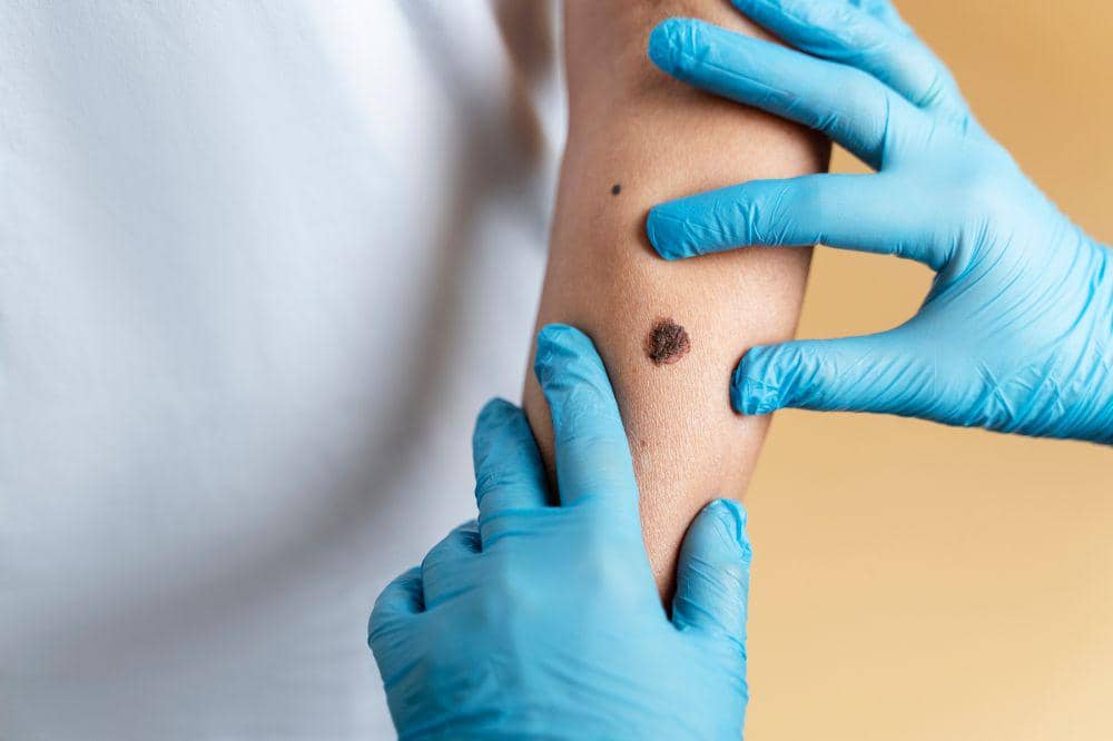 Apa Itu Kanker Kulit Melanoma? Gejala dan Penyebabnya