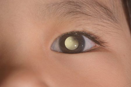 Dari Titik Putih, Mata Kanan Bayi 5 Bulan Hilang