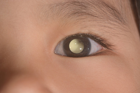 Dari Titik Putih, Mata Kanan Bayi 5 Bulan Hilang